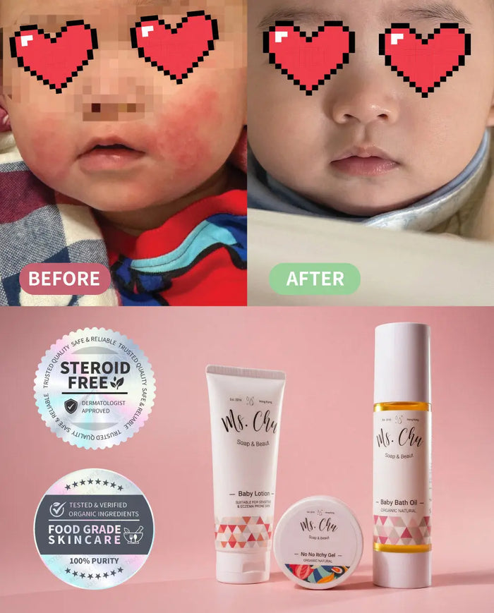Baby Eczema Combo - Ms. Chu Soap & Beaut
